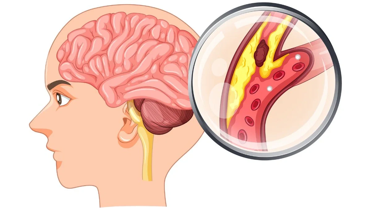 brain eating amoeba