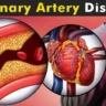Heart disease