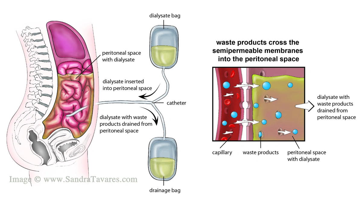 Peritoneal dialysis