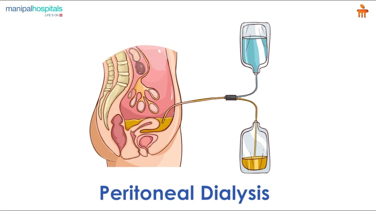 Peritoneal Dialysis | An Untapped Answer to India's Kidney Disease Crisis 2 The Silent Epidemic | Why India Needs More Options