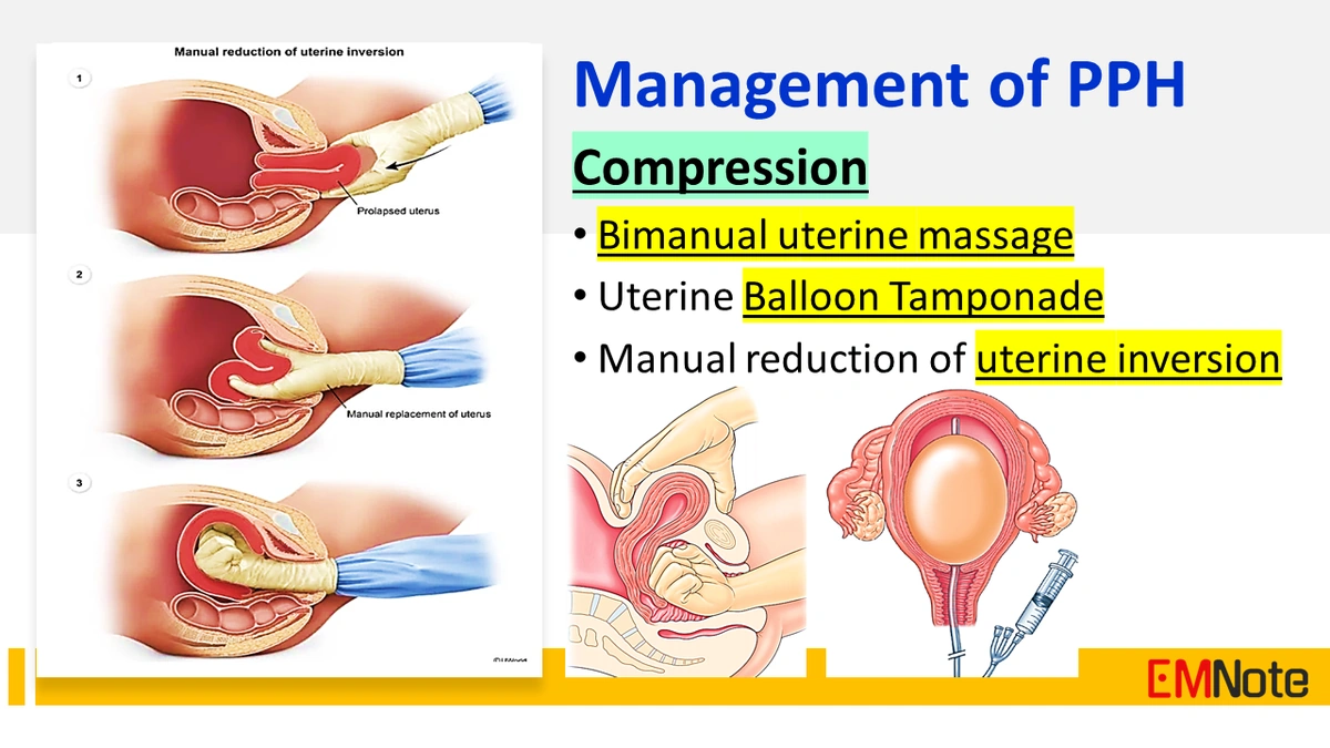 Postpartum Hemorrhage
