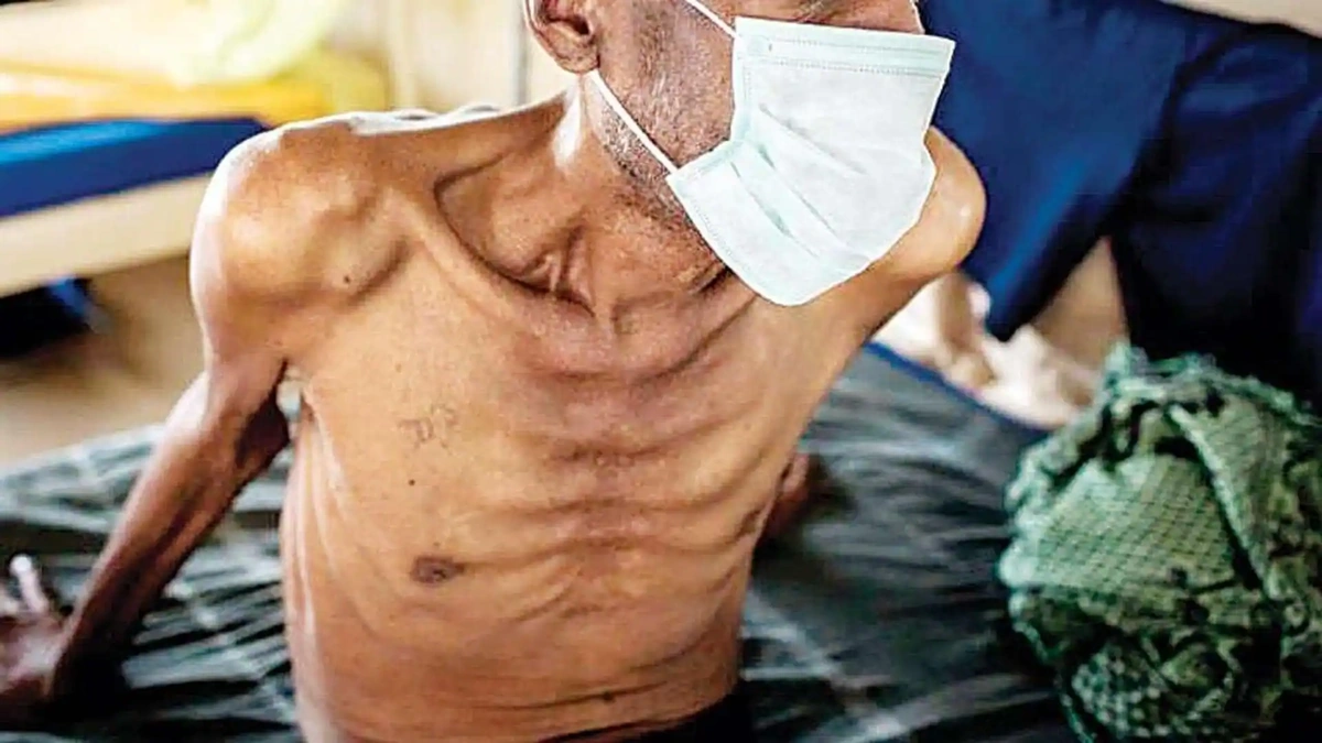 WHO Releases Updated Guidelines for Undernutrition and Tuberculosis 2 Why Updated Guidelines?