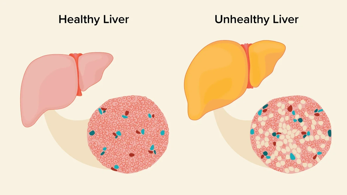 fatty liver