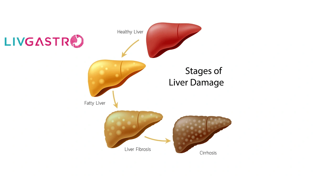 Why Listen to an AIIMS Doctor AboutFatty Liver?